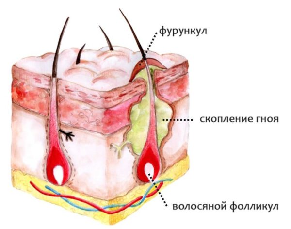 Фурункулез: методы лечения