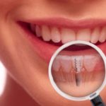 Базальная имплантация зубов: плюсы