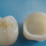 Что из себя представляет циркониевая коронка?
