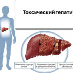 Симптомы токсического гепатита