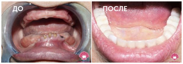 Принципы выбора имплантатов и места их установки