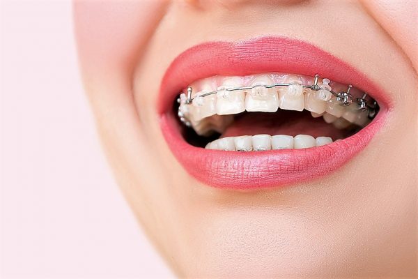 Брекет-системы — чем они отличаются и какую выбрать?