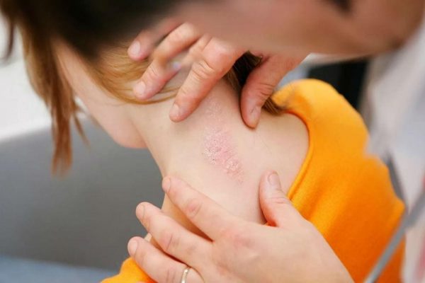 Псориаз: почему возникает и как лечить