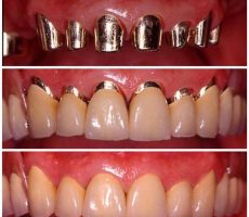 Какие зубные коронки лучше по стоимости?