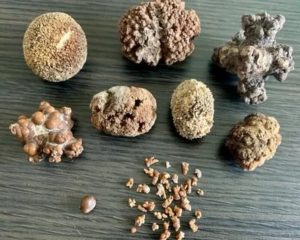Камни в почках: причины, симптомы, лечение