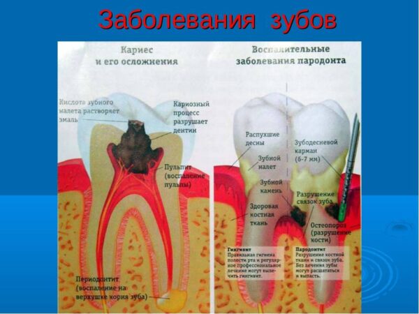 Распространенные болезни зубов и как их лечить?