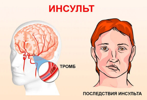 К каким врачам нужно ходить после инсульта