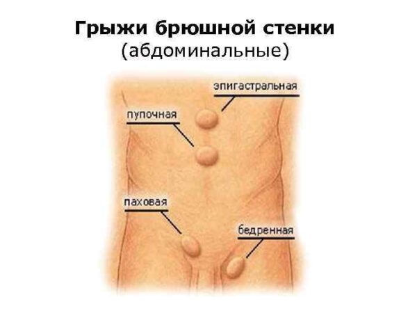 Практика хирургии одного дня при грыже передней брюшной стенки
