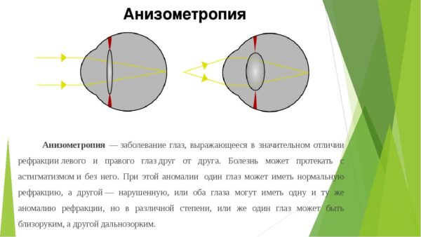 Что такое анизометропия?