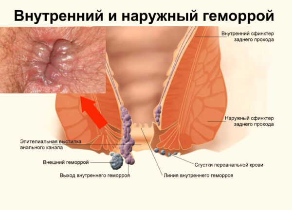 Лечение наружного геморроя