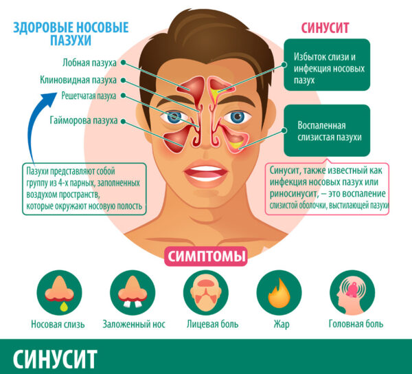 Фронтит: причины, основные симптомы и лечение