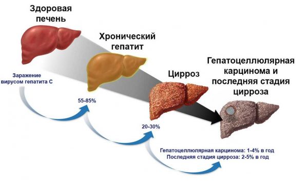 Как лечат хронический гепатит с