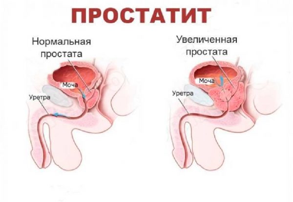Когда следует обратиться к андорологу: симптомы простатита