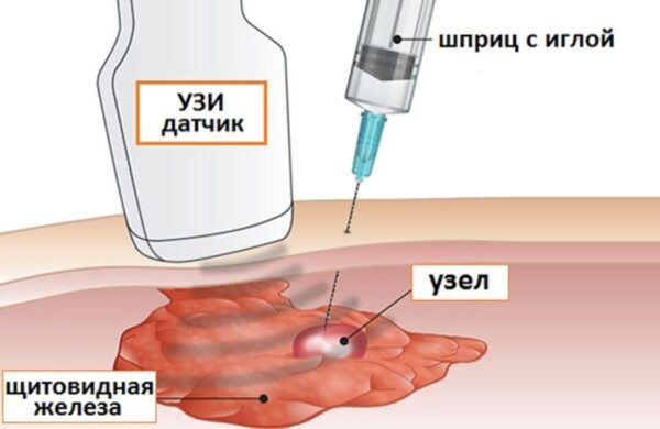 Тонкоигольная биопсия щитовидной железы: основные аспекты и преимущества