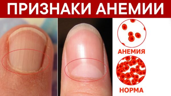 Анемия: симптомы и лечение у женщин