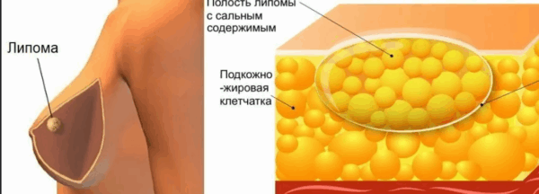 Что такое липома и нужно ли её удалять у ребенка