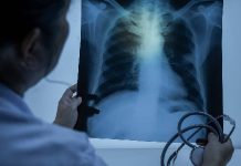 Россиянам раскрыли три главных фактора риска рака легкого