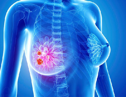 Cancer Medicine: лекарства от изжоги снижают выживаемость при раке груди