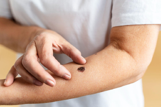 Какие родинки говорят о раке кожи? Полное руководство по самодиагностике и защите