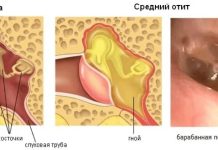 Отит у ребёнка: как понять и что делать рядом с ним