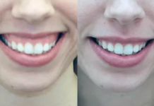 Коррекция smile: как сделать улыбку вашей сильной стороной