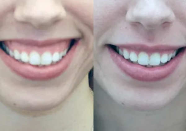 Коррекция smile: как сделать улыбку вашей сильной стороной