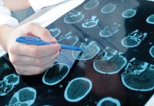 Врач назвал нетипичные признаки опухоли головного мозга