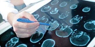 Врач назвал нетипичные признаки опухоли головного мозга