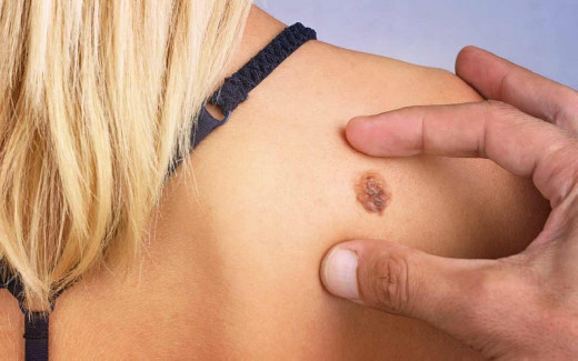 Выявлен недооцененный фактор риска распространенного вида рака