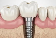 Имплантация зубов: вернуть улыбку без лишнего страха