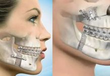 Улыбка без комплексов: как исправление прикуса меняет повседневную жизнь