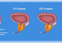 Симптомы, диагностика и лечение рака простаты 2 стадии